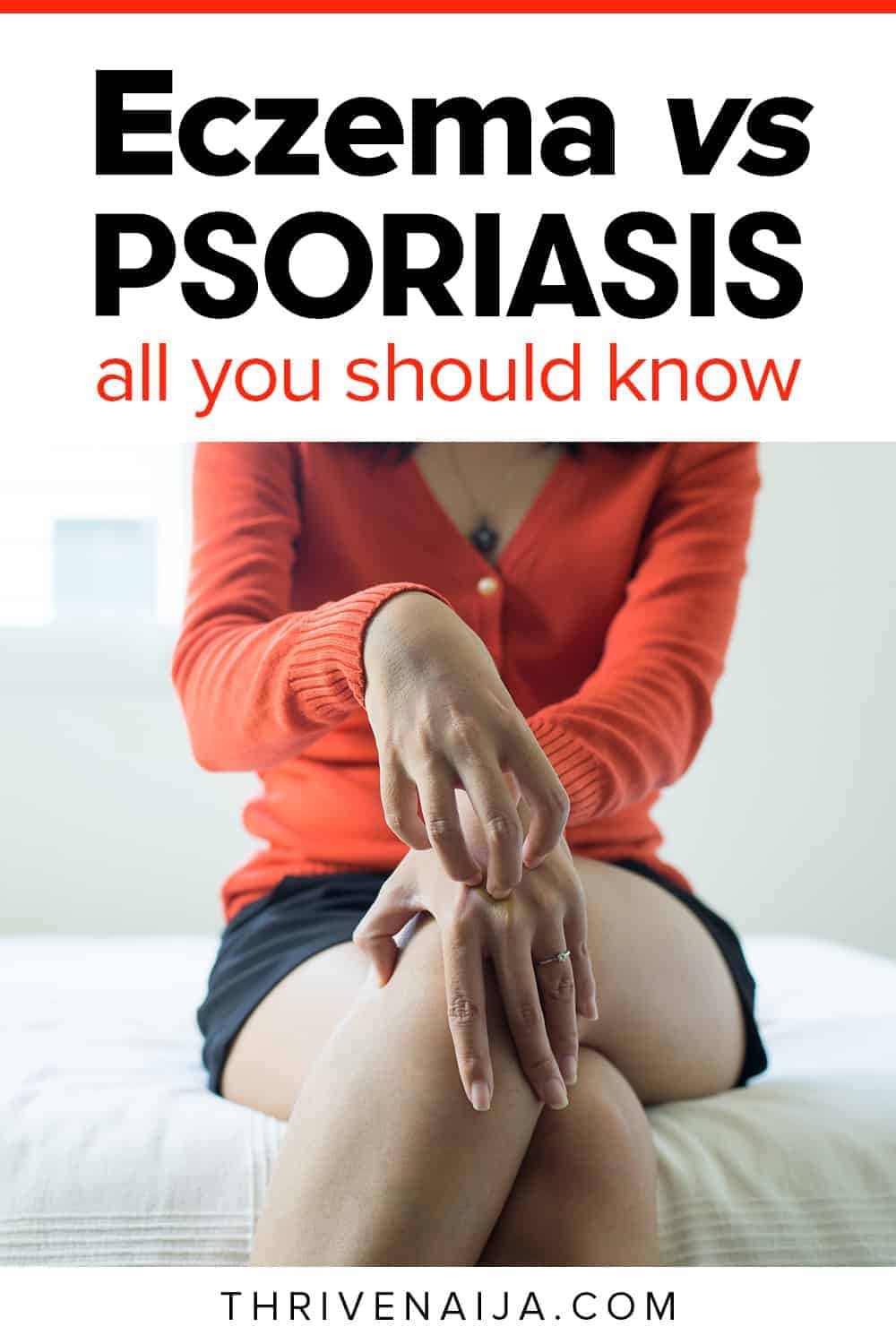 eczema vs psoriasis