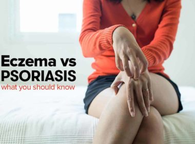 eczema vs psoriasis skin infection
