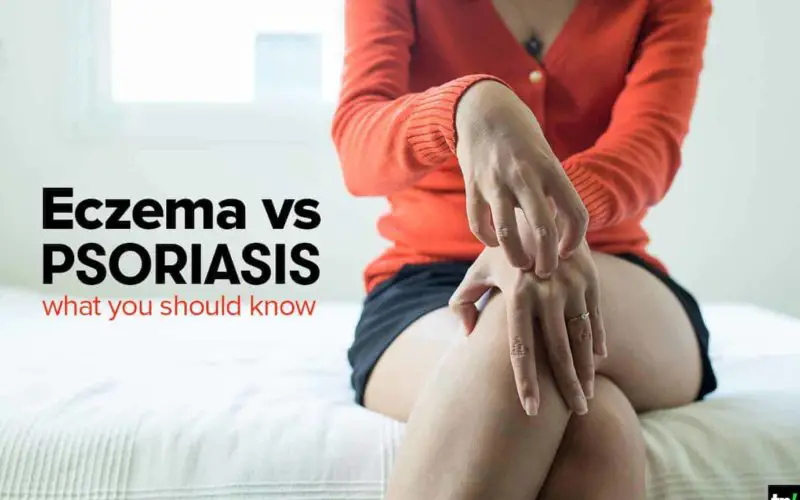 eczema vs psoriasis skin infection