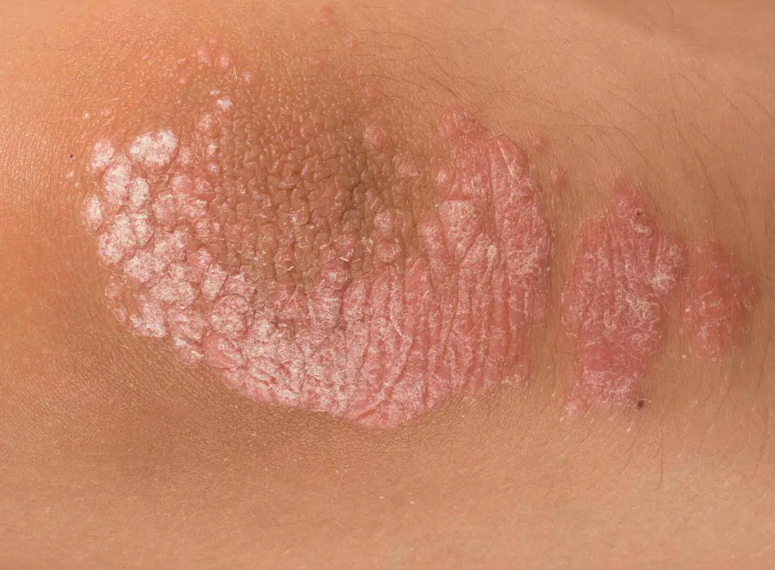 what psoriasis looks like